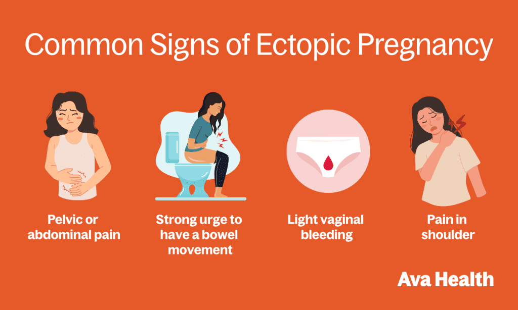 Checklist graphic showing common ectopic pregnancy symptoms including pelvic pain, light bleeding, and shoulder pain.