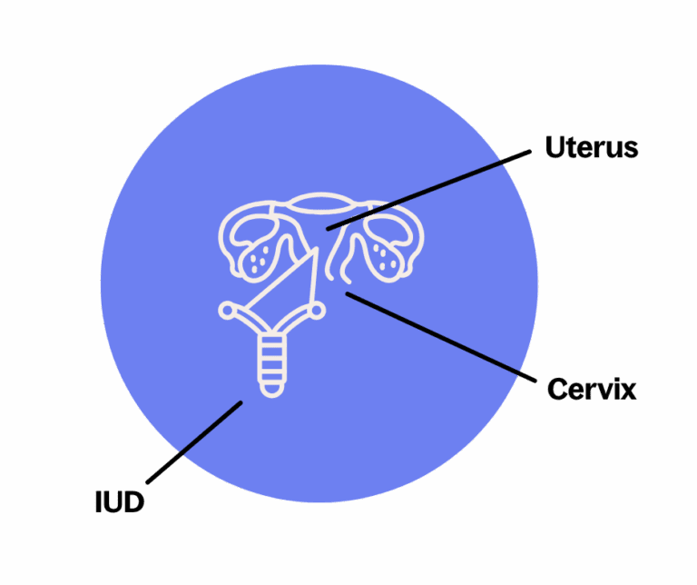 What Is an IUD? Birth Control Explained In Simple Terms