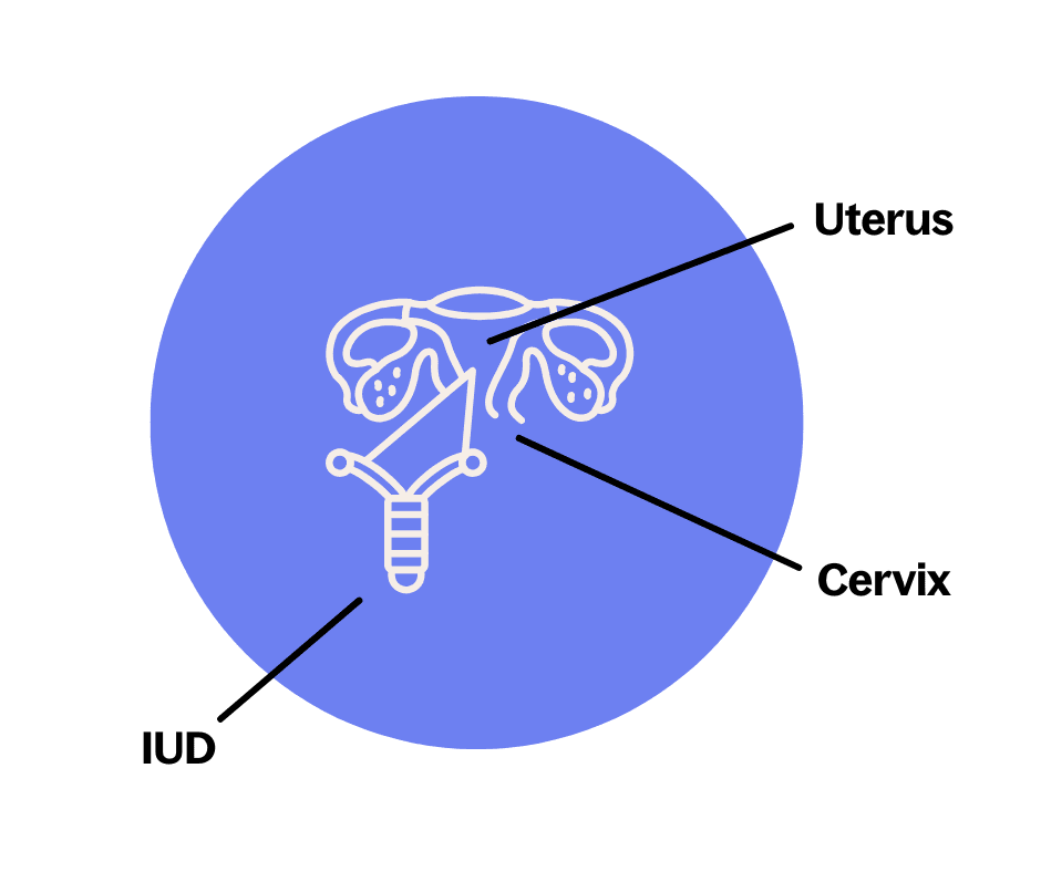 Diagram showing how an IUD works inside the uterus for birth control, labeled with uterus, cervix, and IUD placement – Ava Health